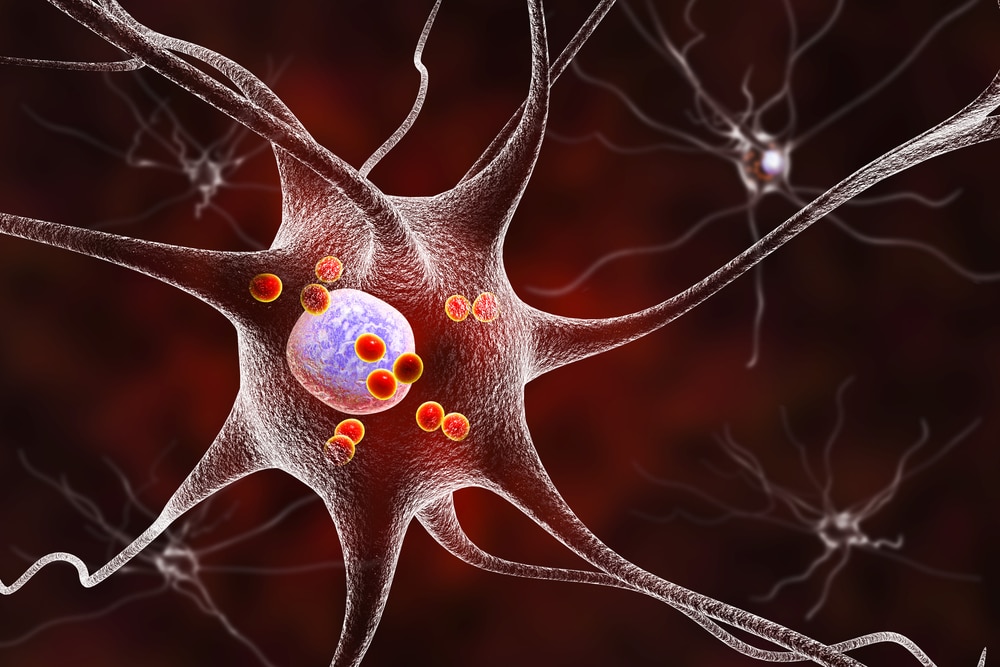 neurons in parkinson's disease graphic illustration