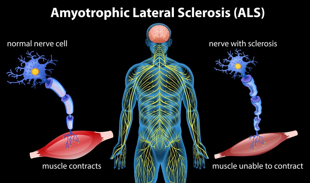 illustration of anatomy of amyotrophic lateral sclerosis