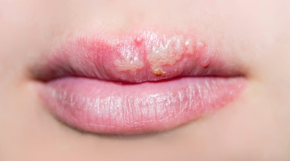 Female lips with herpes sore