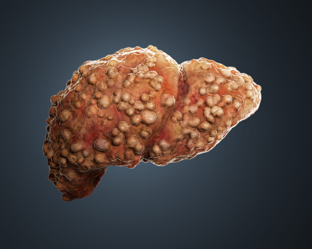 3D rendered cirrotic liver